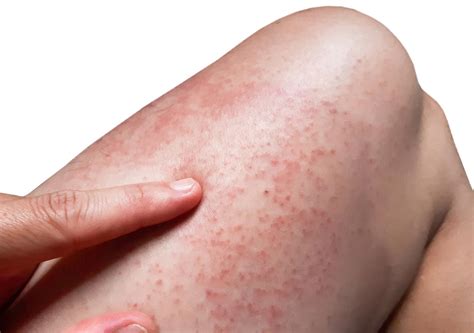 Lifestyle Changes That Can Help Manage the Cuese Blue Rash
